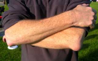 Бурсит: что это такое и особенности его лечения