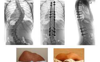 Операции на позвоночник с металлоконструкцией при грыже, сколиозе