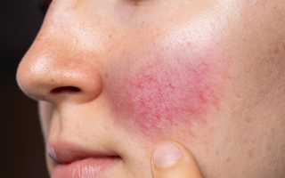 Покраснение на лице, возле носа, на щеках. Как убрать, раздражение, аллергию, зуд