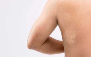 Белые пятна на теле. Причины и лечение, как избавиться народными средствами