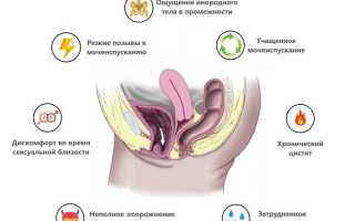 Опущение мочевого пузыря у женщин. Симптомы, лечение, гимнастика, таблетки