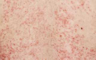 Красная сыпь на теле у взрослого чешется. Что это такое, фото, причины и лечение