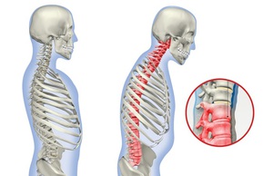 Болезнь Бехтерева Болезнь Бехтерева у женщин