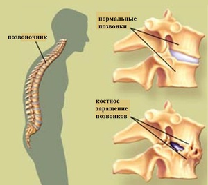 Болезнь Бехтерева у мужчин - проявление Болезнь Бехтерева у мужчин вызывает постоянную