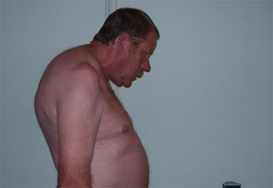 Мужчина в позе просителя - болезнь Бехтерева Что такое болезнь Бехтерева и как она проявляется