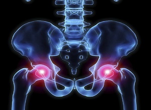 Болезнь Пертеса Диагностика головки бедренной кости.