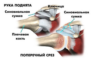 Как проявляется плечелопаточный периартрит и как его можно вылечить