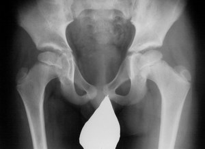 Вторая стадия болезни Пертеса Изменение в тазобедренном суставе