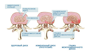 Диагностика грыжи - наглядная схема