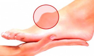 Как выглядит гигрома на ноге