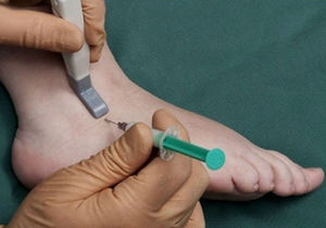 Гигрома и ее лечение