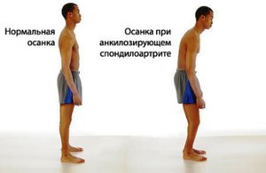 Инстраграма осанки при болезни Бехтерева Инстраграма осанки - здоровый позвоночник и болезнь Бехтерева