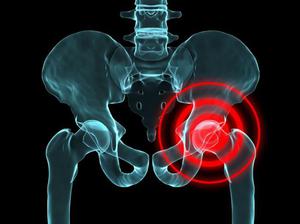 Факторы и признаки хзаболевания Болезнь Пертеса