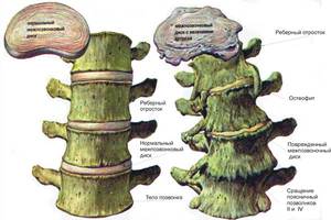Какие могут быть изменения в позвоночнике