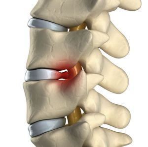 Лечение остеофитов