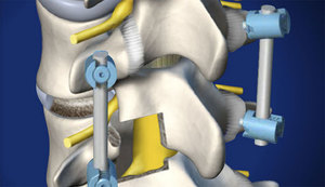 Металлоконструкция позвоночник