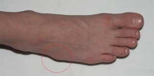 Как проявляется гигрома