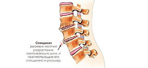 Почему разрастаются остеофиты