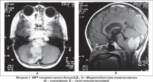 Особенности цефалгии в разных случаях