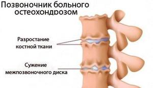 ВСБ при шейном остеохондрозе