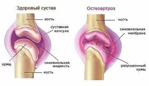 Лечение остеоартроза коленного сустава