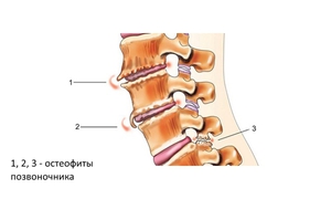 Что такое остеофиты поясничного отдела 