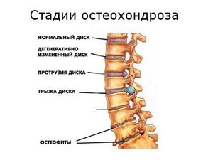 Симптомы заболевания