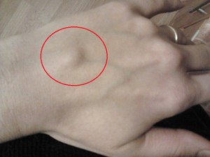Шишка на кисти  может появиться по нескольким причинам