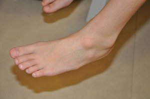 Как вылечить гигрому