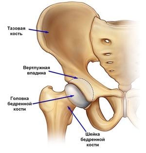 Методы лечения некроза Лечение некроза тазобедренного сустава