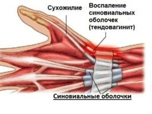 Осложнения при заболевании