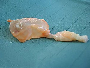 Обычно гигрому просто удаляют хирургическим путем