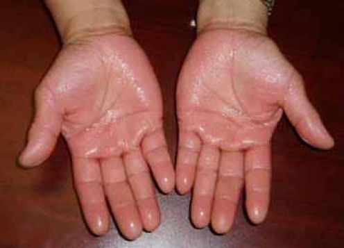 Когда потеют руки - что делать?