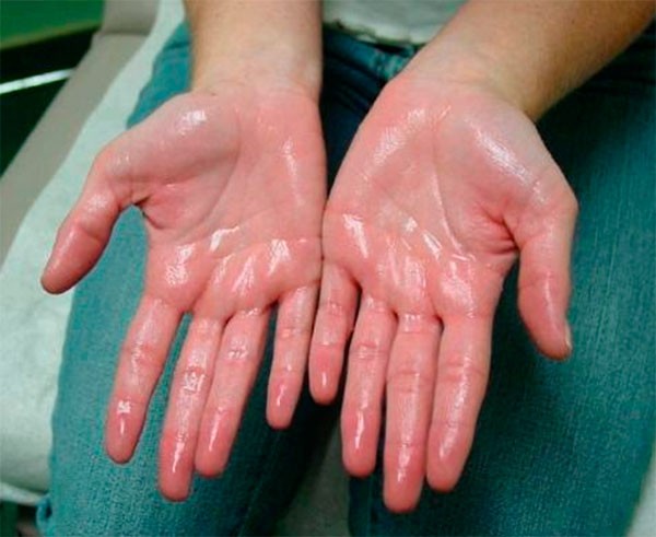 Когда потеют руки - что делать?