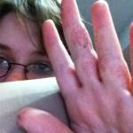 Как появляется псориаз на руках - симптомы, стадии и причины возникновения