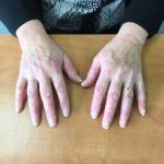 Как появляется псориаз на руках - симптомы, стадии и причины возникновения