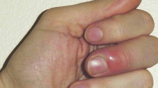 Нарывает палец после маникюра: Почему? Что это значит? Как лечить?