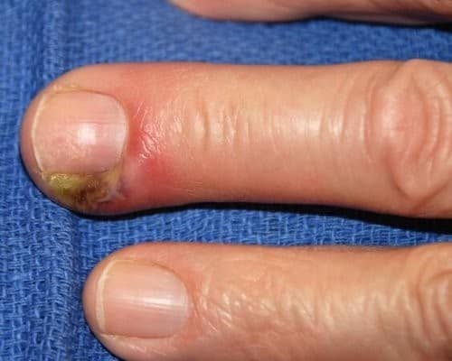 Что делать с воспалением после маникюра