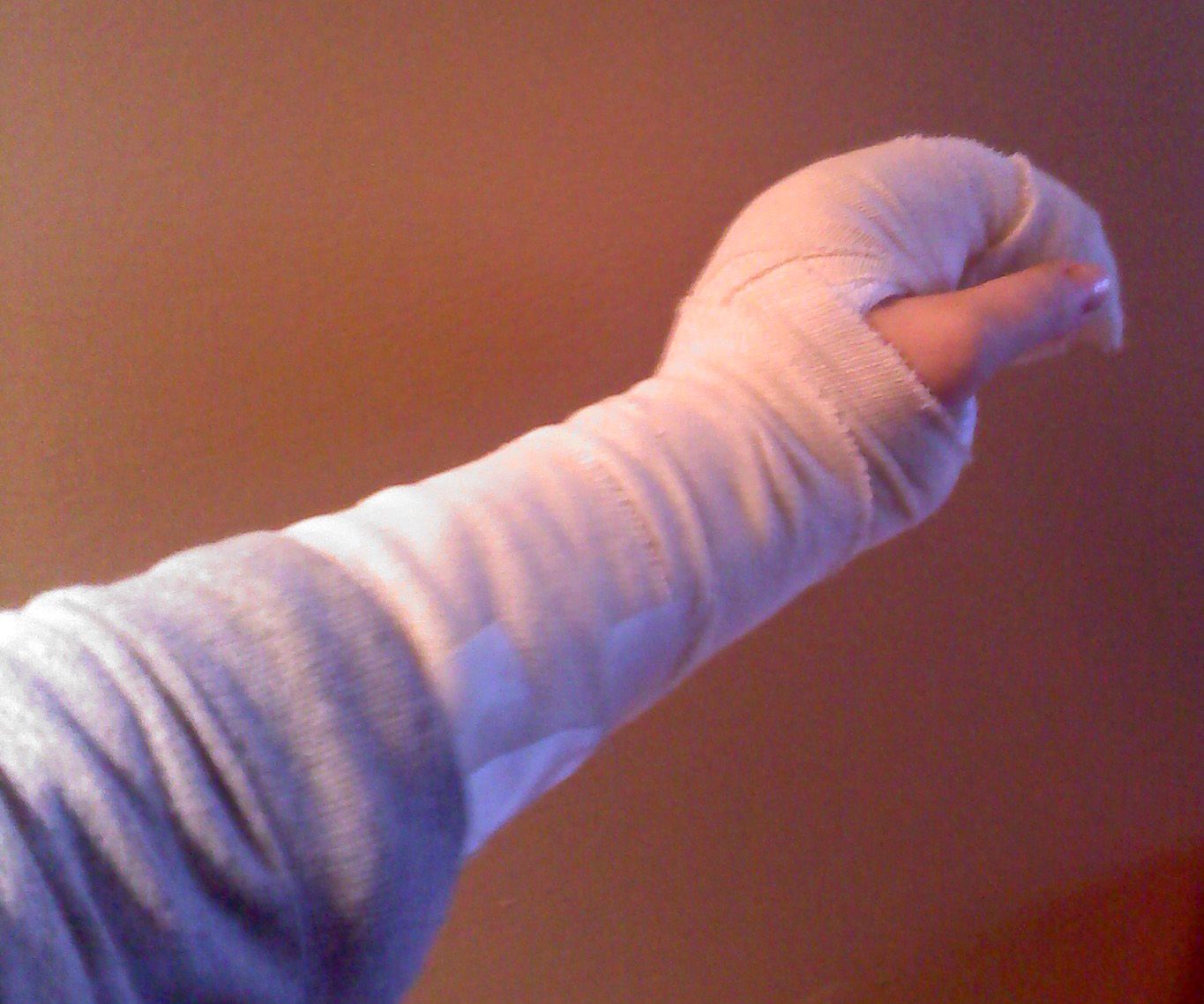 Ожог руки - что делать?