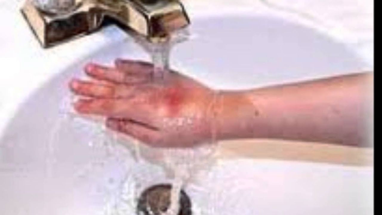 Ожог руки - что делать?