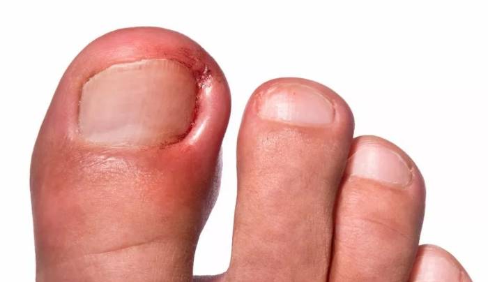 Вросшие ногти на ногах