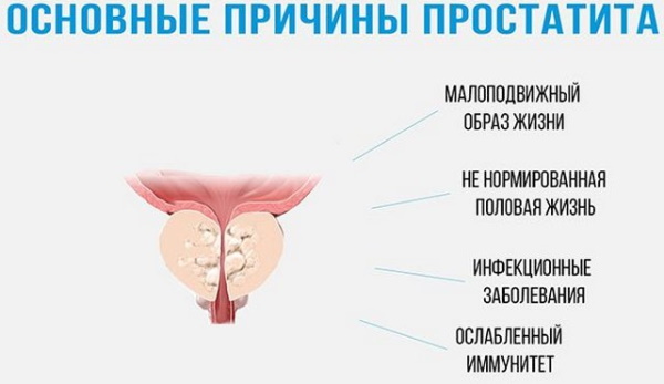 Абактериальный хронический простатит. Что это, симптомы, лечение
