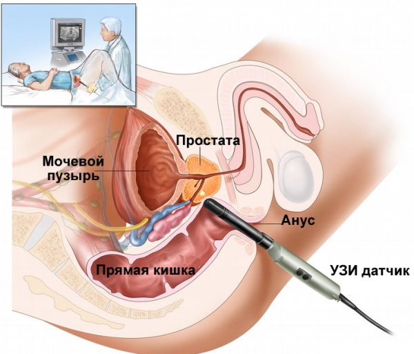 Абактериальный хронический простатит. Что это, симптомы, лечение