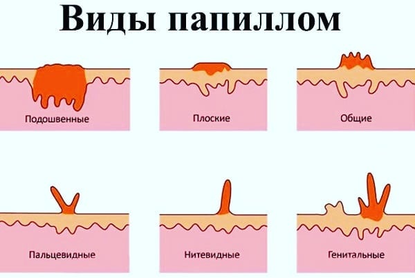 Анализ крови на папилломавирус у женщин, мужчин, детей. Причины ВПЧ инфекции