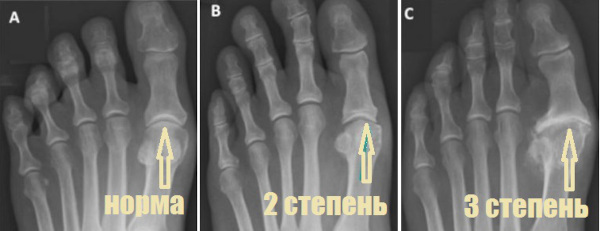 Артроз большого пальца ноги. Лечение народными средствами