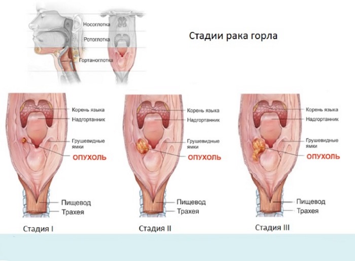 Боль в горле при глотании без температуры - острая, сильная, режущая, с одной стороны, если отдает в ухо. Лечение в домашних условиях