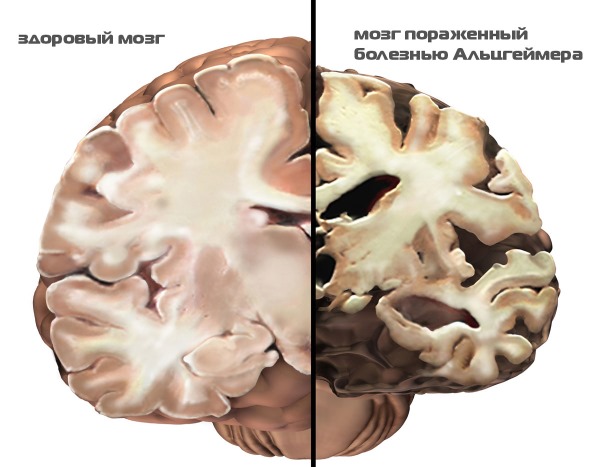 Болезнь Альцгеймера. Симптомы, лечение, препараты, народными средствами