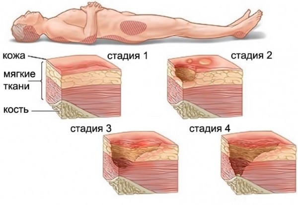 Болезнь Альцгеймера. Симптомы, лечение, препараты, народными средствами