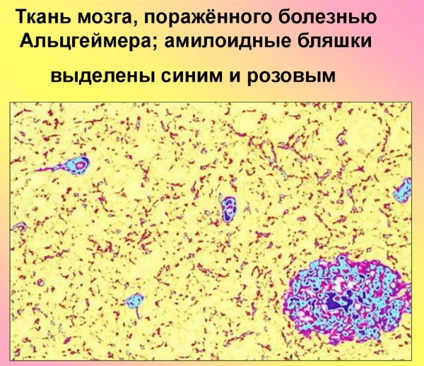 Болезнь Альцгеймера. Симптомы, лечение, препараты, народными средствами
