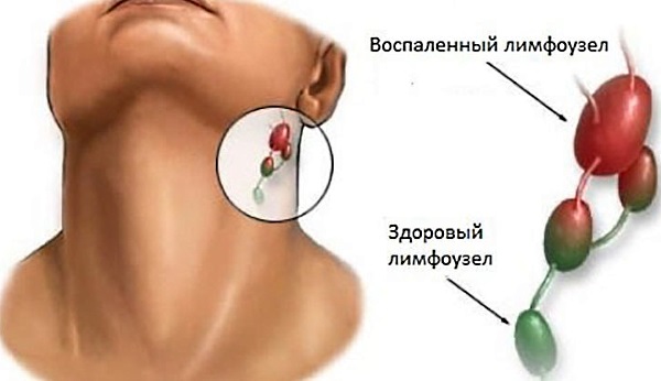Цитомегаловирус у женщин. Симптомы, лечение